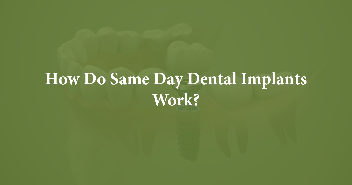 How Do Same Day Dental Implants Work? at Southwest Oral Surgery